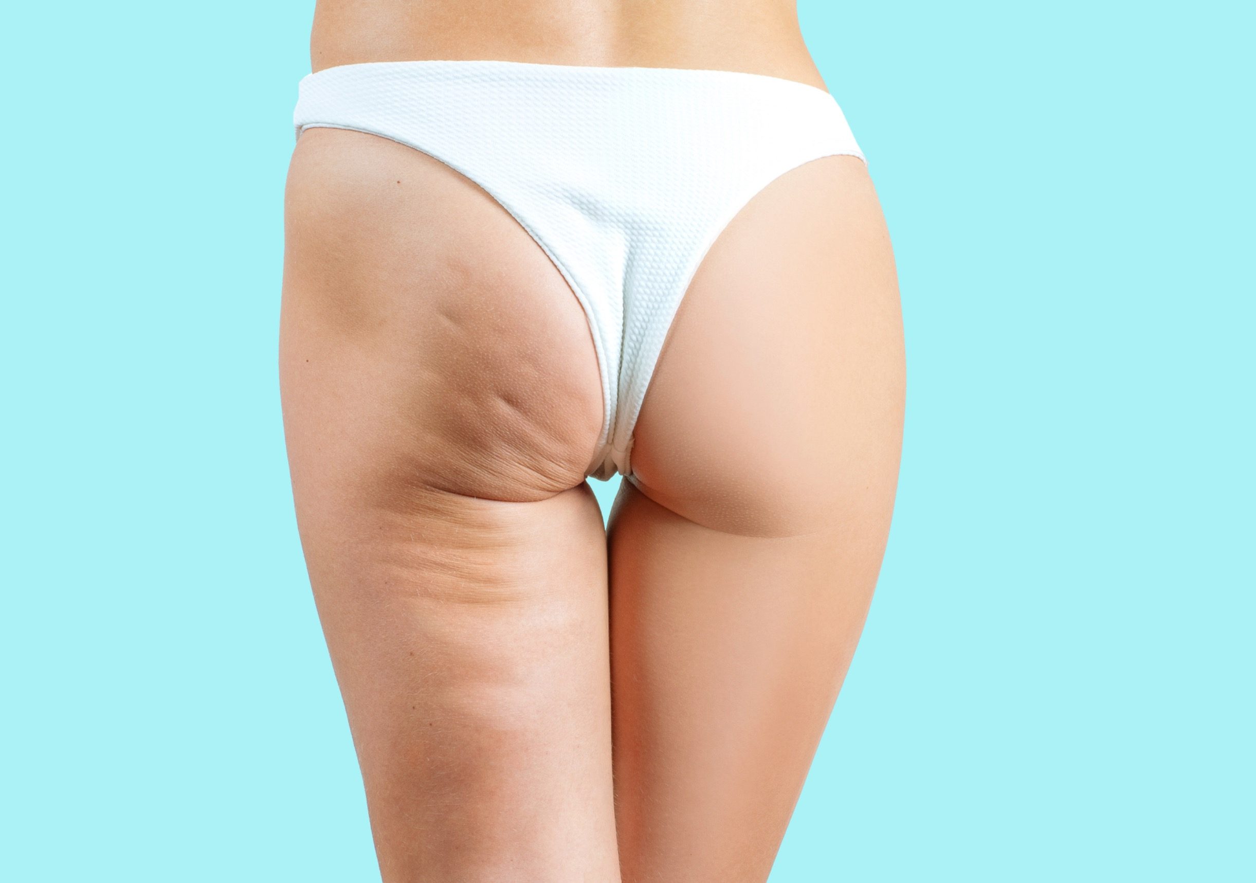 Sculptra gegen Cellulite